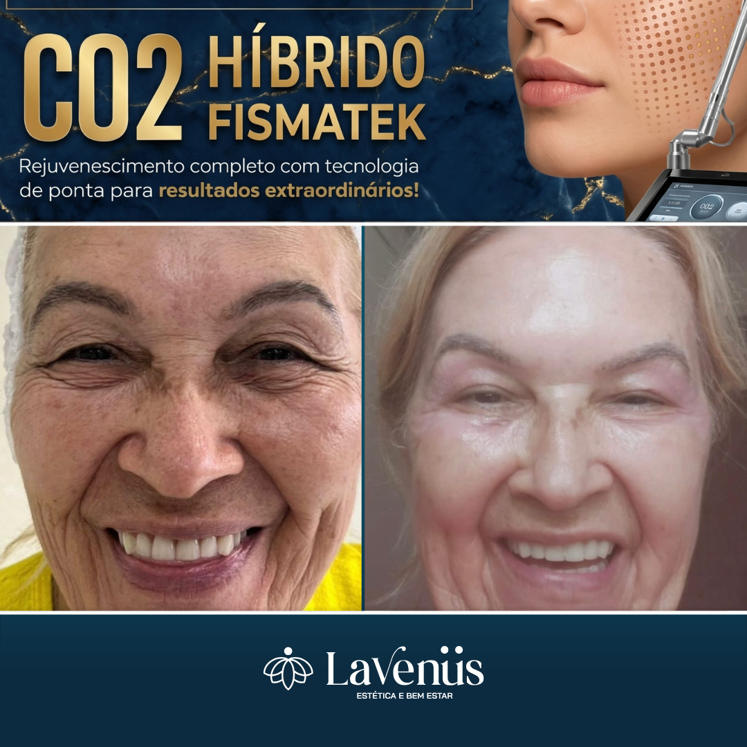 Resultado antes e depois — paciente 1 da Lavenus Estética