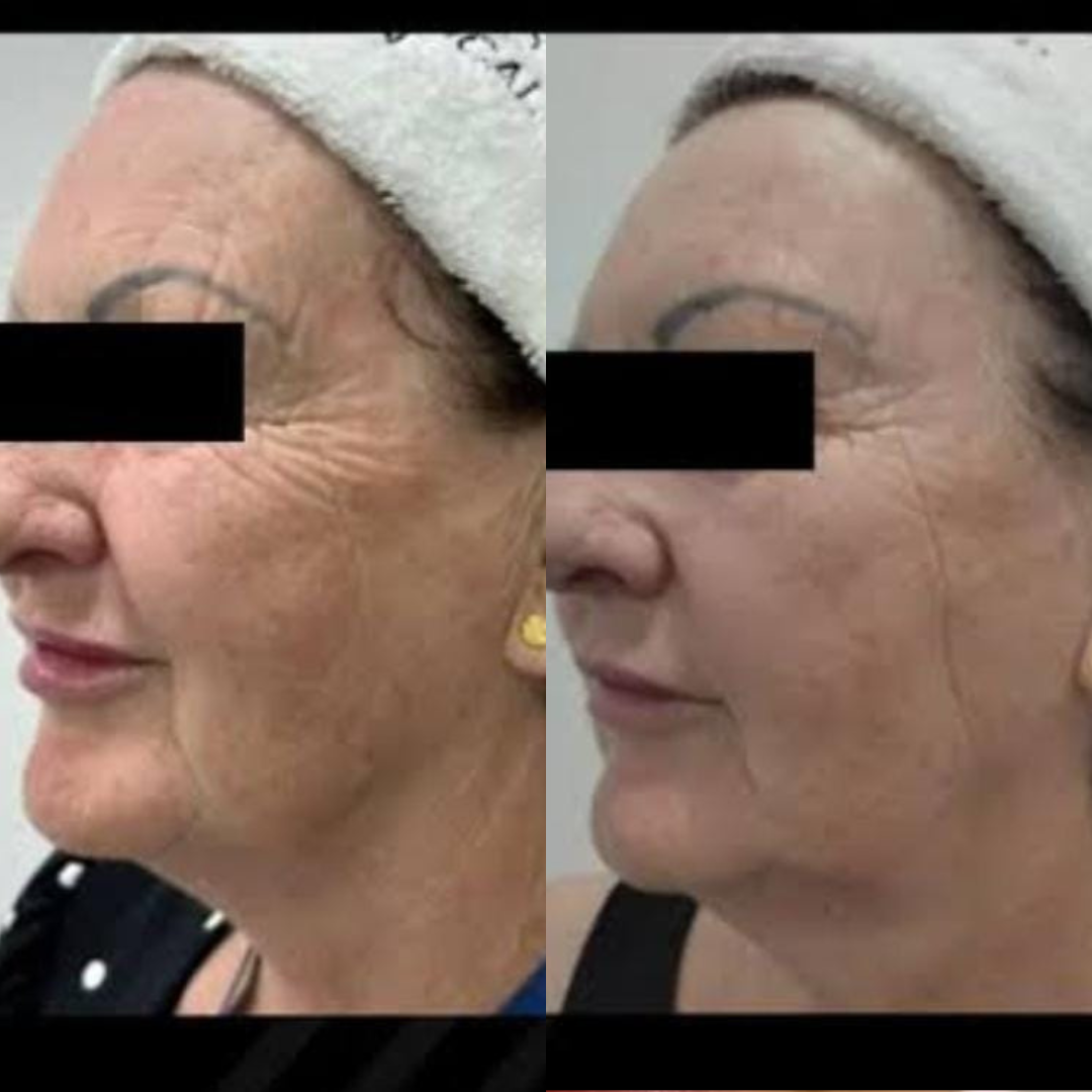 Resultado antes e depois — paciente 2 da Lavenus Estética