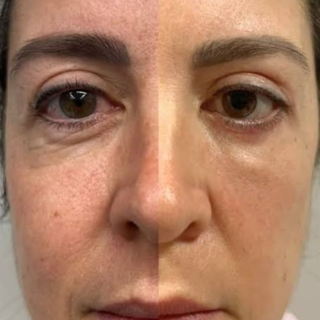 Resultado antes e depois — paciente 3 da Lavenus Estética