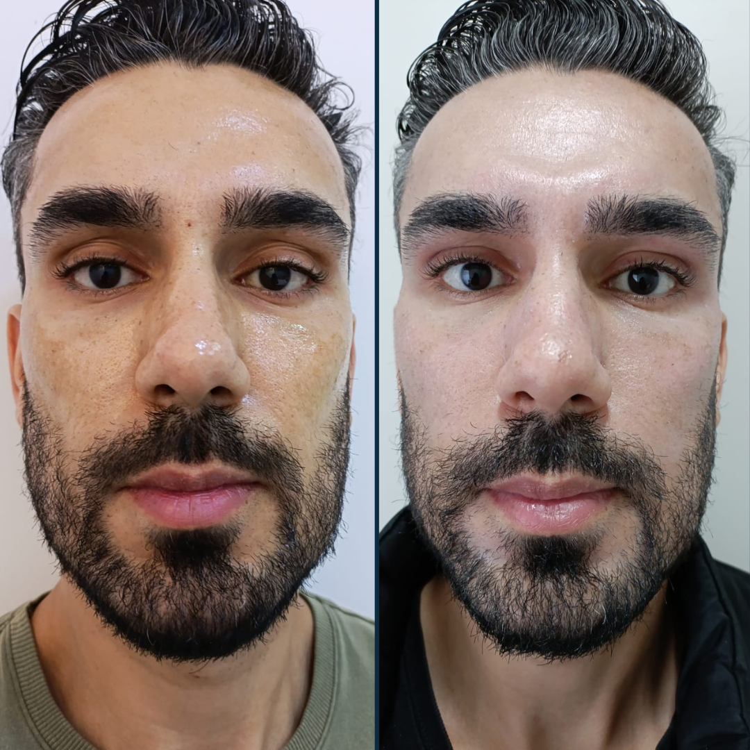 Resultado antes e depois — paciente 4 da Lavenus Estética